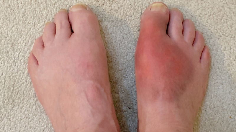 Pied gonfle par la goutte